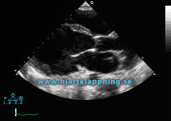 Hjärtsvikt - ultraljudsundersökning av hjärtat ekokardiografi eller hjärtinkompensation (EKO)